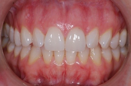 Gingivito požymiai: raudonos dantenos